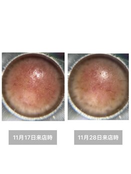 雪中花ナルシサス(narcisse)の写真/シミくすみ何をやっても変わらない…肌崩れ前に初回判断＋予防ケアで未来の美肌をサポート☆