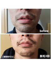 エステティック らぽーる(Rapport)/ヒゲ爆抜けモード