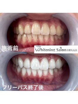 ホワイトニングサロン 京都烏丸店/ホワイトニング施術例