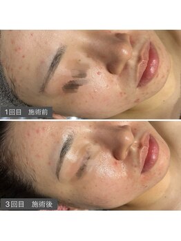 ロッタ エクリュ(Lotta ecru+)/REVI剥けないハーブピーリング