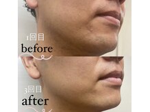 さつき整骨院/ヒゲ脱毛