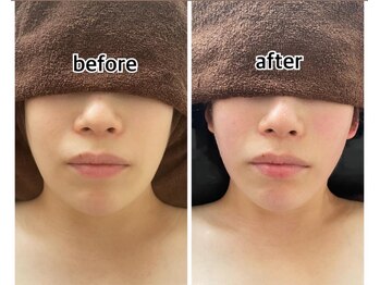 インディバジェム(GEM)/ビフォーアフター