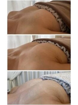 美人バスト 町田店/バストアップ◇症例◇