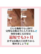 ホワイトアクア 天王寺本店(WHITE AQUA)/ハーブピーリング/大阪/天王寺