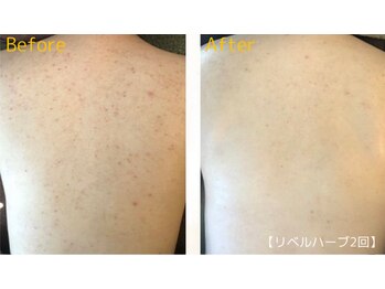 ロイヤリティ(ROYALTY)/ブライダルケアハーブピーリング