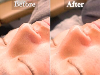 ボーンオム(Born Homme)/毛穴洗浄＋美容液導入：30代女性