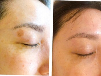 ナチュラルセラピー ドロップ(Drop)/レーザーなしでシミが消えました