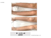 ドルチェビューティーサロン 戸塚安行店(Dolce Beauty Salon)/脱毛（脚）_施術4回
