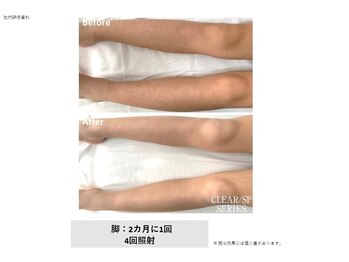 ドルチェビューティーサロン 戸塚安行店(Dolce Beauty Salon)/脱毛（脚）_施術4回
