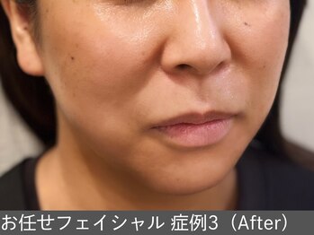オアシスラグーン(OASIS LAGOON)/お任せフェイシャル(症例3)