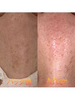 アモリアージュ(Amolliage)/韓国式3D毛穴洗浄