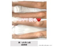 アルーア(Allure)/ヒザ下脱毛♪before after