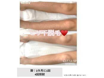 アルーア(Allure)/ヒザ下脱毛♪before after