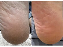 地爪ケアクリニックサロン 松江/ガザガザかかとは早めのケアを