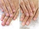 【深爪矯正】憧れの美爪に変わる