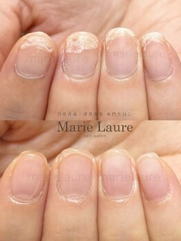 マリーロール 淀屋橋本店(Marie Laure)/自爪育成/深爪矯正/ネイルケア