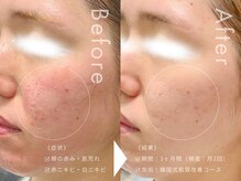 セルフミー 恵比寿(SELF Me...)の雰囲気（スキンケアで改善しなかった肌悩みにも効果抜群♪）