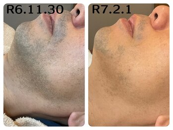 フィズ 五日市彩が丘店(FIS)/☆美肌脱毛☆佐伯区脱毛