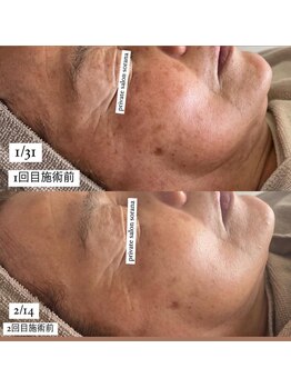 ソラナ(sorana)/ガリレオピーリング