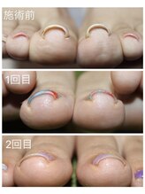 カルペ ディエム(Carpe diem)/結果が出る巻き爪矯正