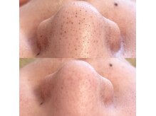 オハダ(ohada)の雰囲気（韓国式3D毛穴洗浄/黒ずみ、詰まりを除去）