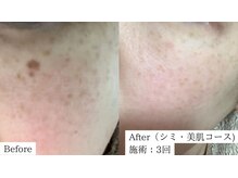 【医師監修】シミ/毛穴/たるみケア専門店 Frohの雰囲気(たるみ/開き毛穴/大人の肌へ*ダウンタイム無しのエイジングケア)