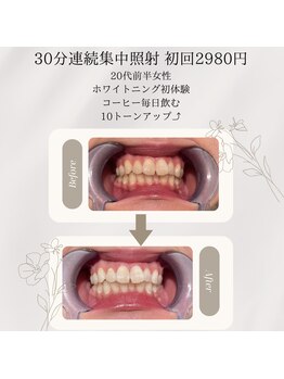 プラスビーセルフ(+b self)/ホワイトニングビフォーアフター