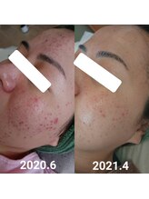 トリエ(TORIE)/大人ニキビケアにエルモサハーブ