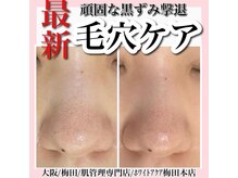 ホワイトアクア 梅田本店(WHITE AQUA)/ハーブピーリング/大阪/梅田