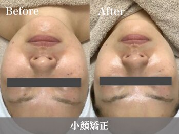 RHB東戸塚/小顔エステはRHB東戸塚