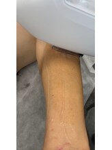 ヘアージュエル ファムファタール(HAIR JEWEL Femme Fatale)/ウデ脱毛