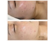 サロン エデンプラス(salon eden PLUS)の雰囲気（敏感肌や繰り返すニキビケアもご相談ください◎）