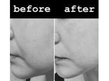 レンリー(Renry)/レモンボトルは、たるみにも◎