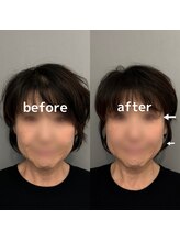 オアソラ(oasora)/美容鍼施術