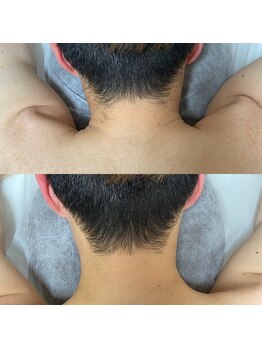 アイラッシュサロン ドール(Doll)/【メンズ】襟足脱毛
