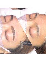 ヴィプラス(Vi+)/