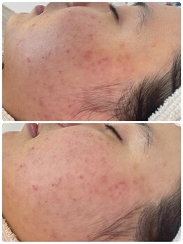 サラシック(salachic)/大人ニキビケア