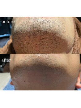 ピーディーエーサロン(PDA salon)/【ヒゲ3回目での効果】