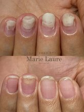 マリーロール 淀屋橋本店(Marie Laure)/深爪矯正/自爪育成/ネイルケア