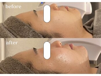 リスタ(RSTA)/【BEFORE/AFTER】