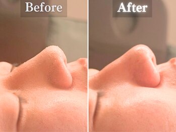 ボーンオム(Born Homme)/毛穴洗浄＋美容液導入：20代男性