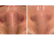 エムフルール 吹田市/毛穴洗浄before／after