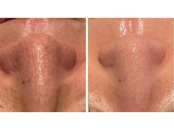 エムフルール 吹田市/毛穴洗浄before／after