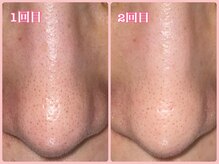 ララン(Laran)/ハイドラフェイシャル