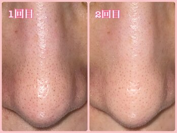 ララン(Laran)/ハイドラフェイシャル