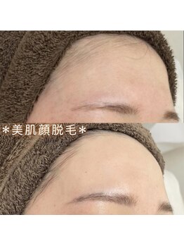 カルディエ(Cardie)/おでこ脱毛　ビフォーアフター