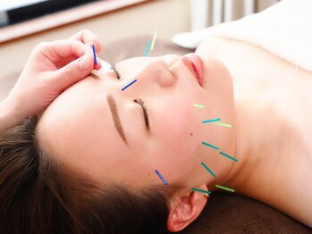 ユキ(YUKI)の写真/ほうれい線・シワ・たるみ改善◎あなたのお悩みに合わせて鍼の太さや本数、打つ場所を変えて行う美容鍼☆