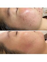 ミラ(Mila)/ニキビケアBeforeAfter