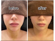 インディバジェム(GEM)/ビフォーアフター