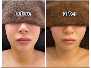 インディバジェム(GEM)/ビフォーアフター